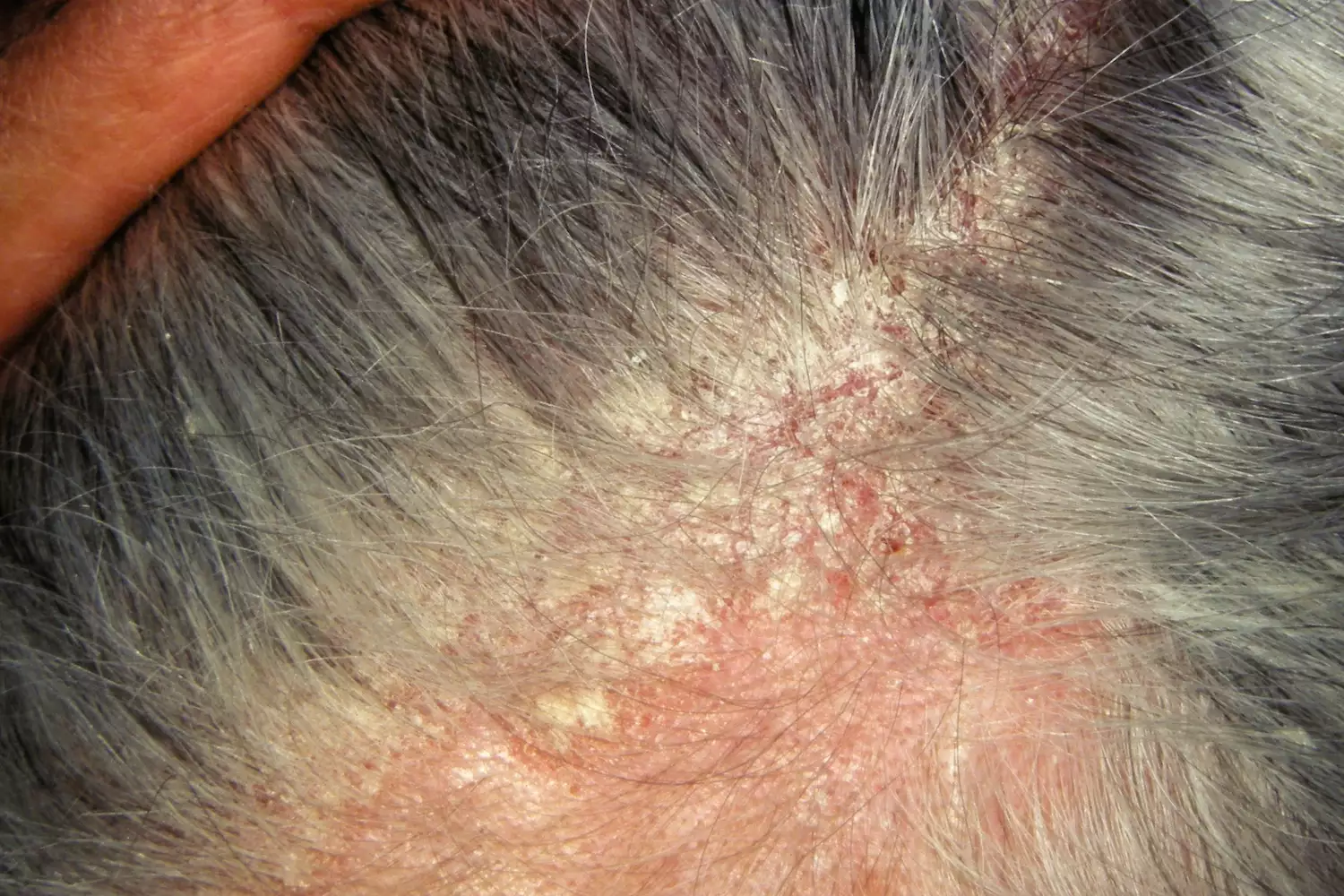 Close-up of seborrheic dermatitis on the scalp showing scaling and redness.