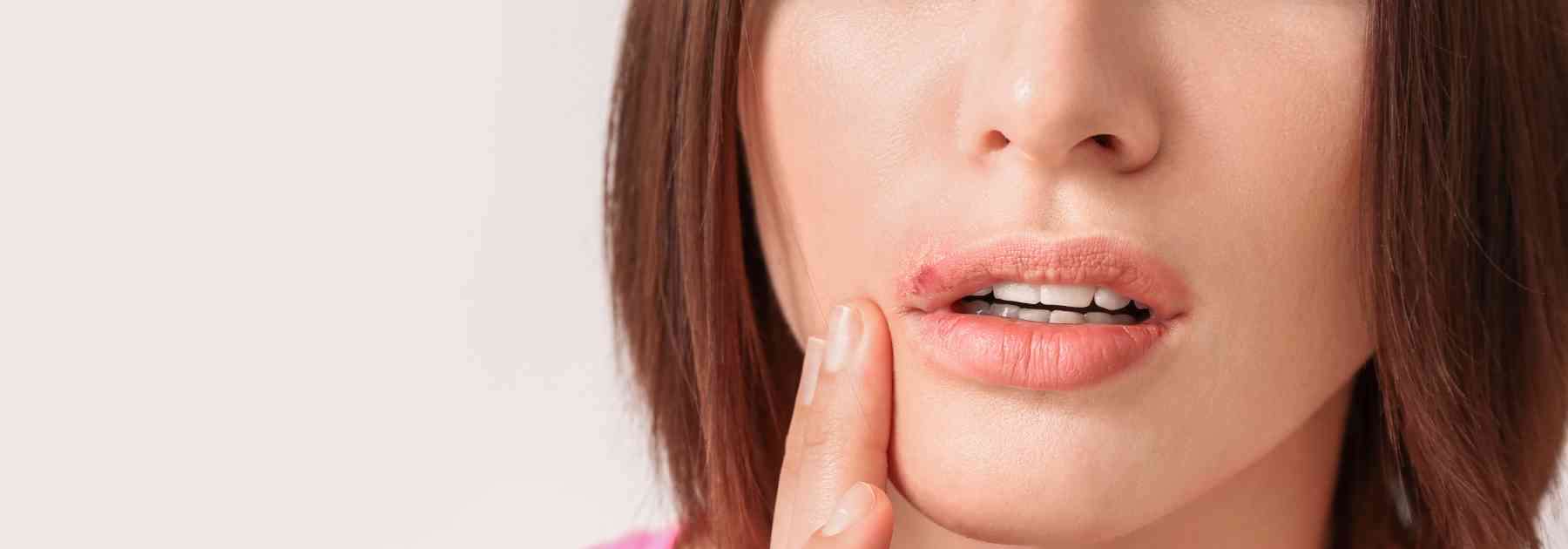 Infographic comparing the appearance and treatment of impetigo and cold sores.