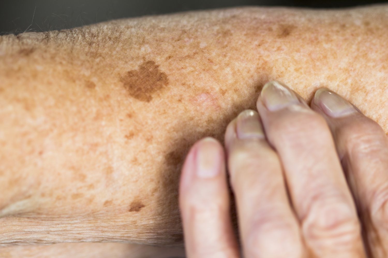 An elderly person's arm with various age spots and one larger, irregular pigmented lesion being examined.