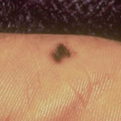 Acral lentiginous melanoma appearing as a dark spot on the sole of a foot.