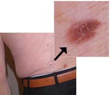 A clinical photograph of a dysplastic nevus on a patient's lower back showing asymmetry.