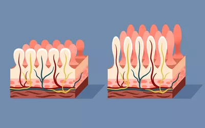 A medical illustration comparing healthy finger-like intestinal villi to flattened and atrophied villi damaged by gluten.