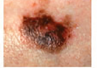 Skin lesion showing shades of black, brown, and red within the same area.