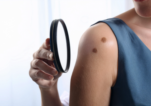 Melanoma Warning Signs: Is That Spot Skin Cancer?