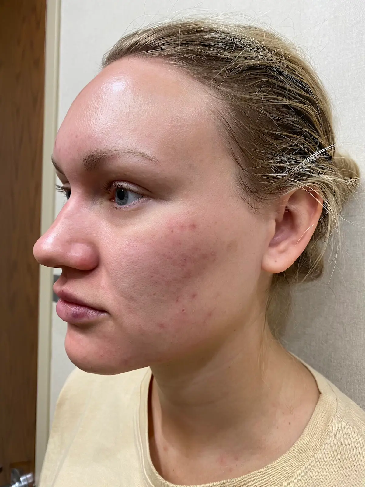 Adult Acne Causes: Why You Still Get Pimples at 30+