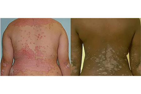 A side-by-side comparison showing psoriasis plaques on a light-skinned person and a dark-skinned person.