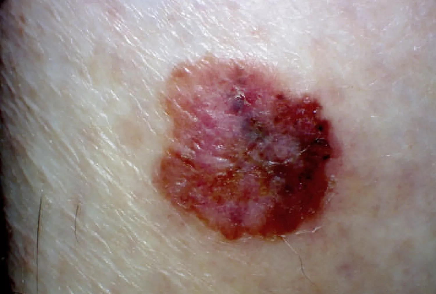 Close-up of a melanoma lesion showing multiple shades of brown and black.