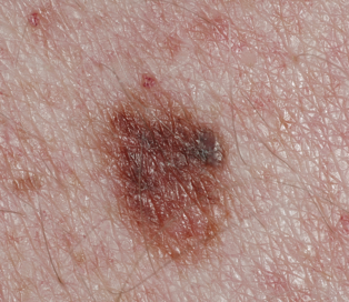 Microscopic view of an atypical mole with irregular features.