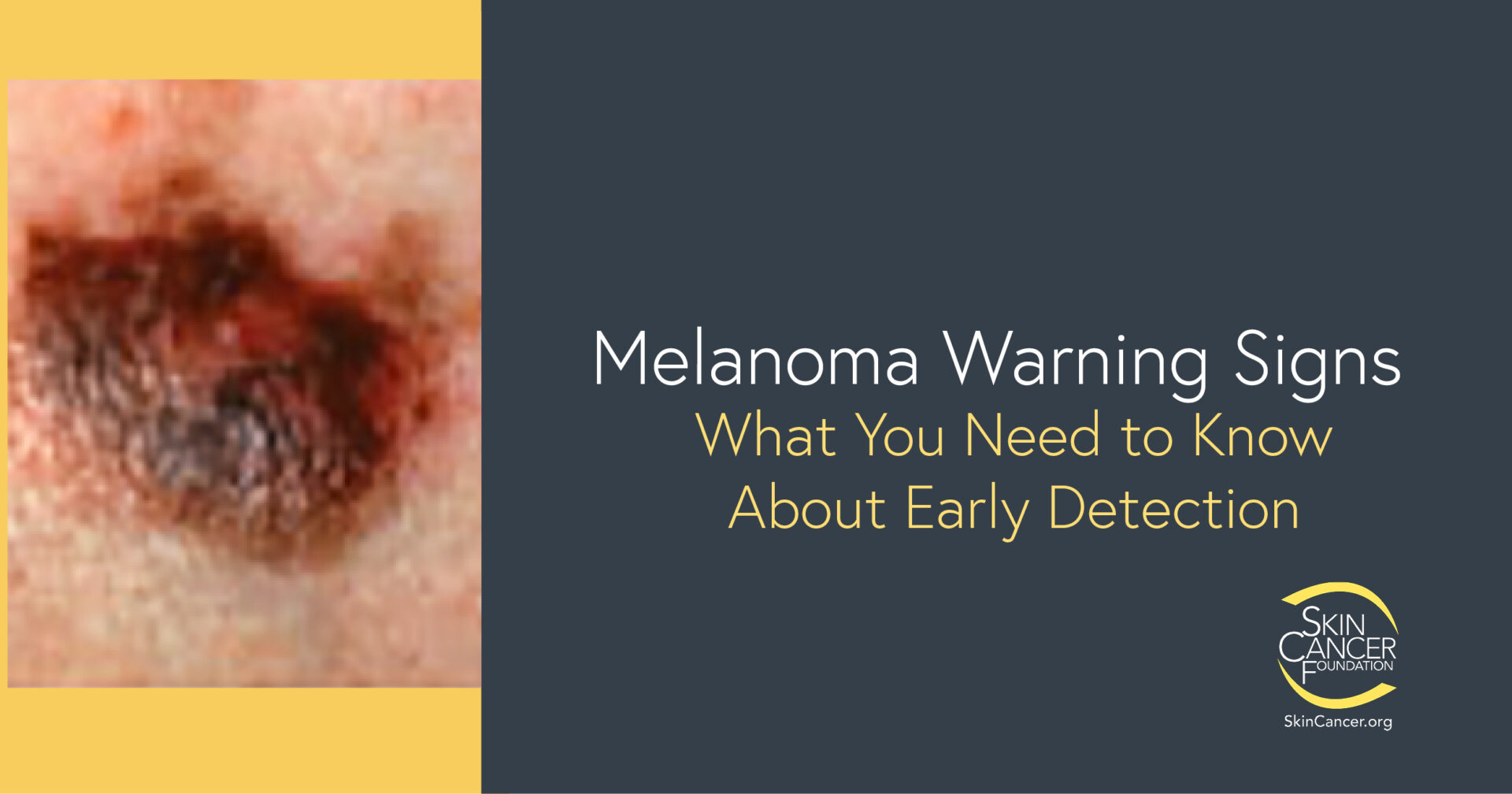 Skin Cancer Signs: How to Identify Dangerous Moles
