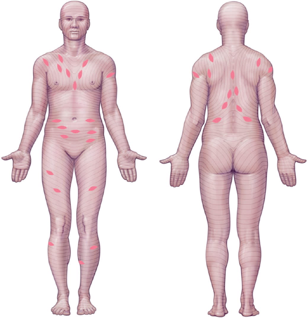 The back of a patient showing multiple small oval pink spots aligned along natural skin folds.