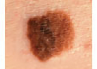 Large melanoma lesion measuring over 6mm in diameter.