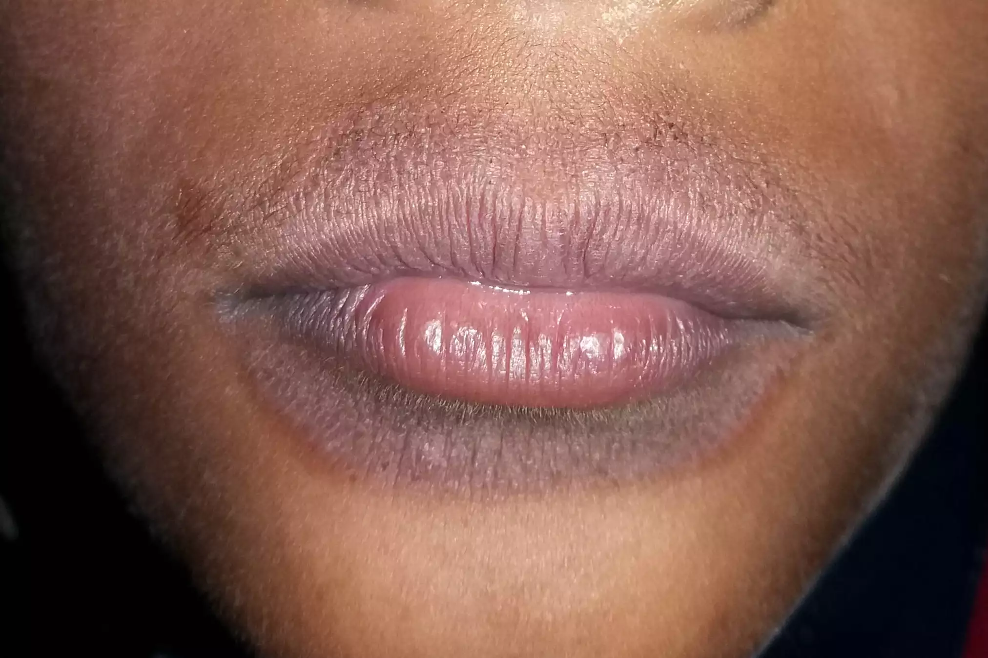Dermatitis symptoms localized around the lips and facial area.