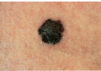 Comparison image showing the progression and growth of a melanoma lesion.