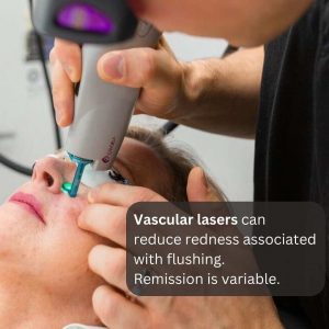 Patient receiving professional laser treatment for facial telangiectasia.