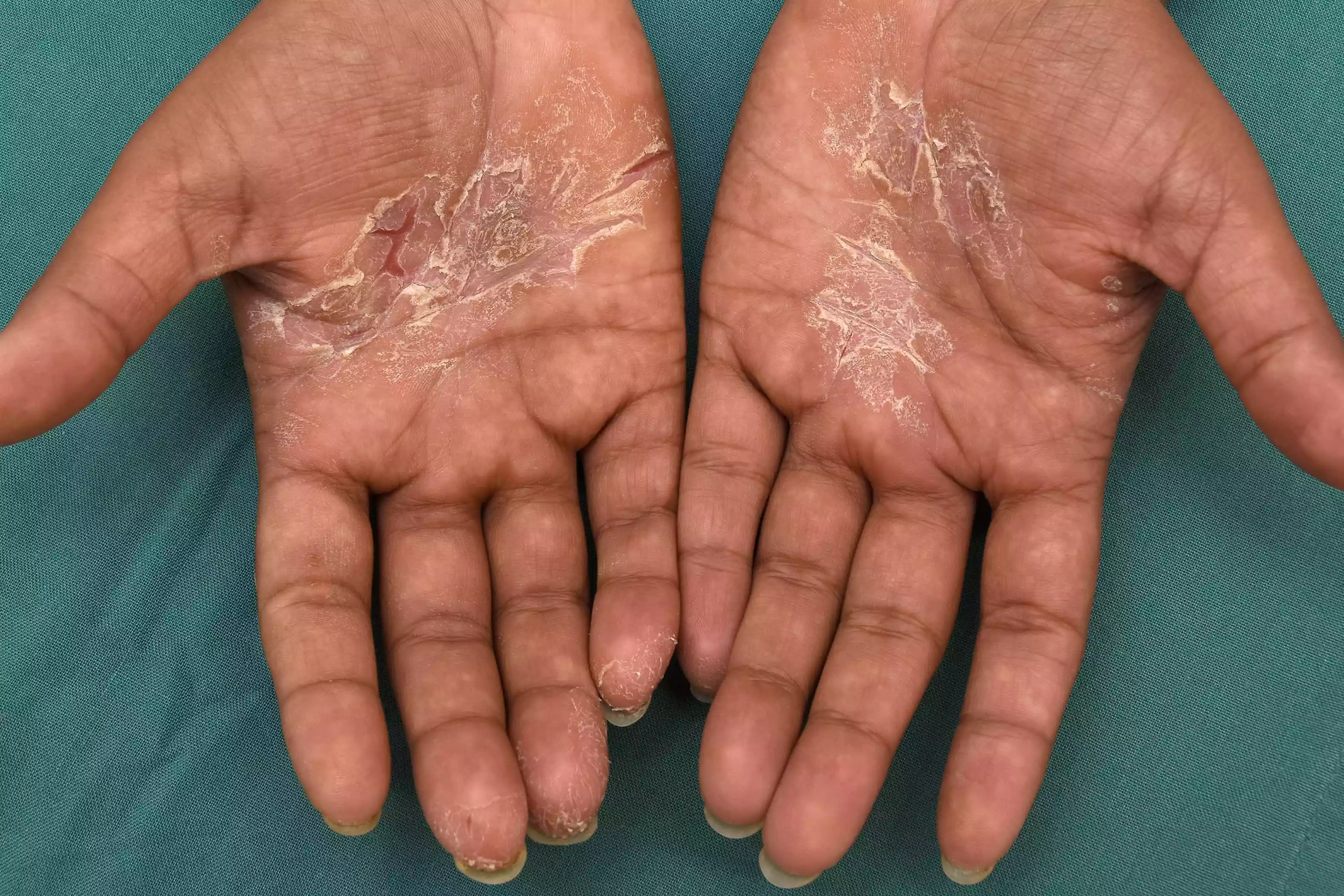 Clinical view of contact dermatitis affecting the skin on the hands.