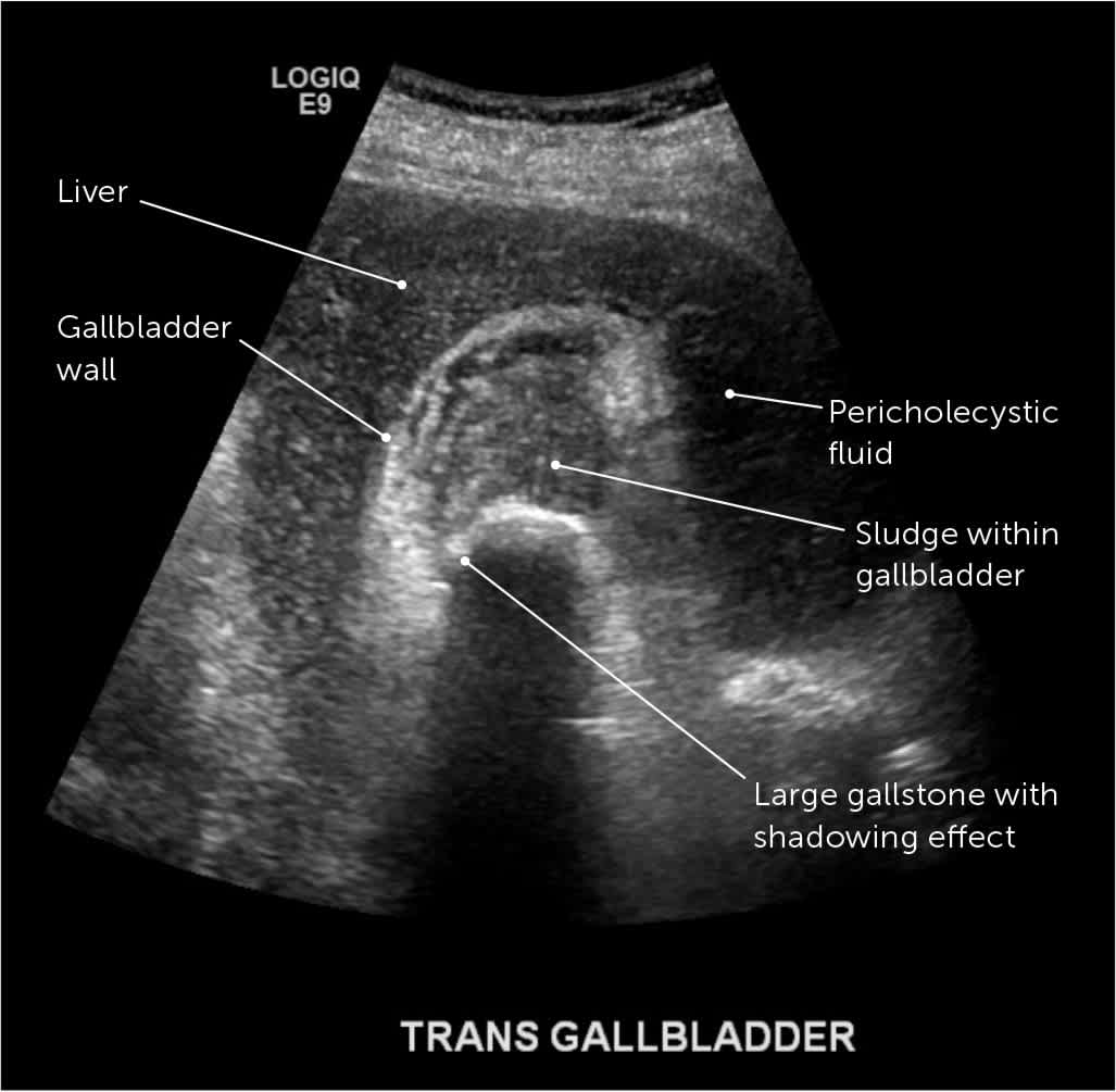 An ultrasound scan of the upper right quadrant revealing acute cholecystitis and a gallstone.