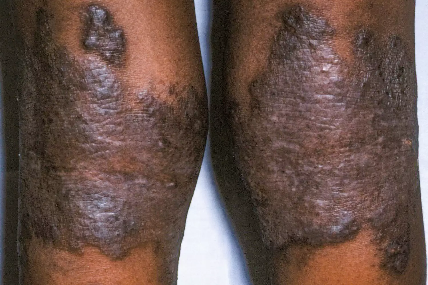 A close-up clinical photograph of atopic dermatitis on human skin.