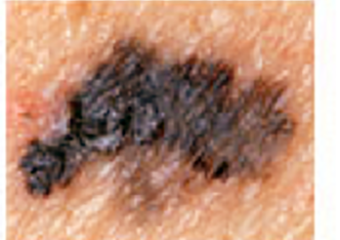 Melanoma lesion with uneven and blurred borders.