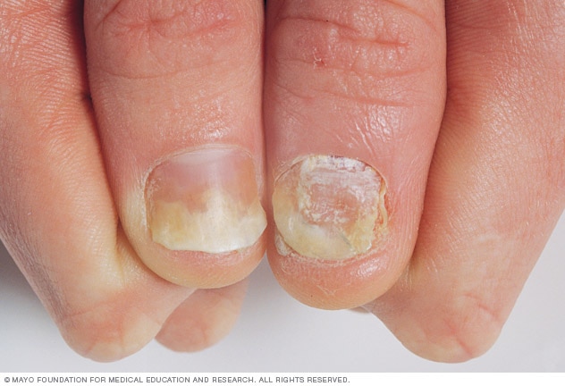 Detailed view of fingernails showing surface pitting, thickening, and discoloration characteristic of psoriatic arthritis.