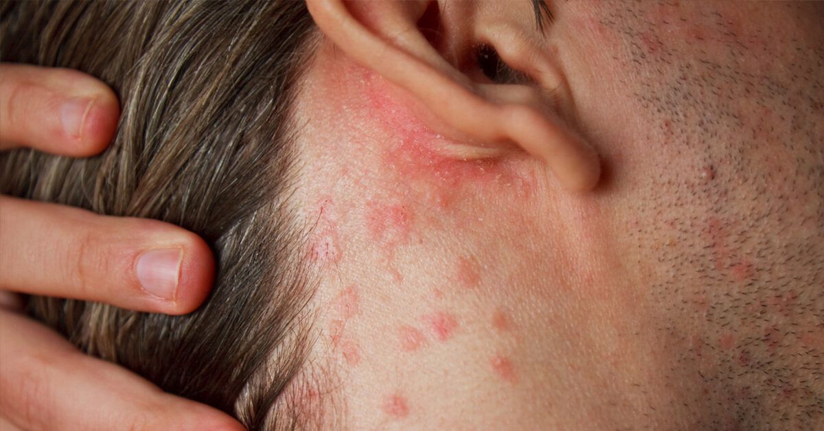 A high-quality clinical or lifestyle photo representing the management of chronic skin and joint conditions.