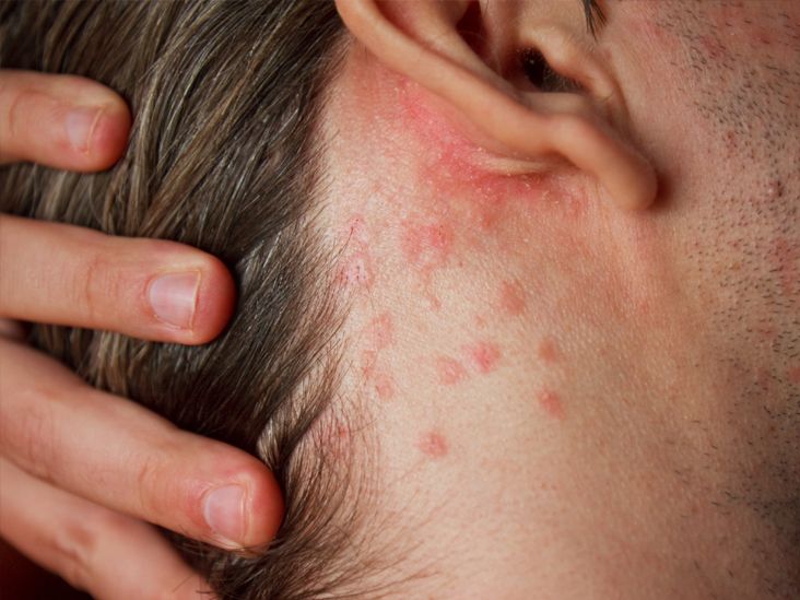 Managing Psoriasis and RA: Expert Daily Tips