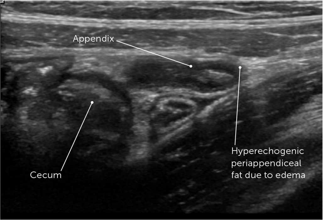 A medical ultrasound image showing a cross-section of acute appendicitis in the bowel.