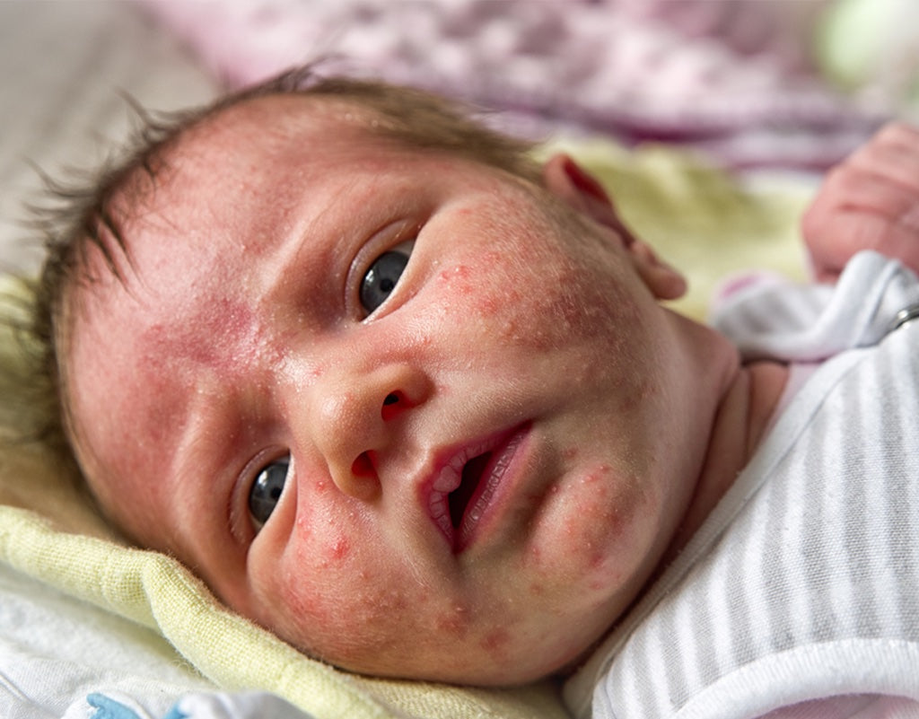 Baby Acne: Causes, Treatments, and Safety Tips