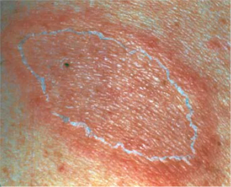Close-up of a single oval pink lesion with a ring of fine white scales at the edge.