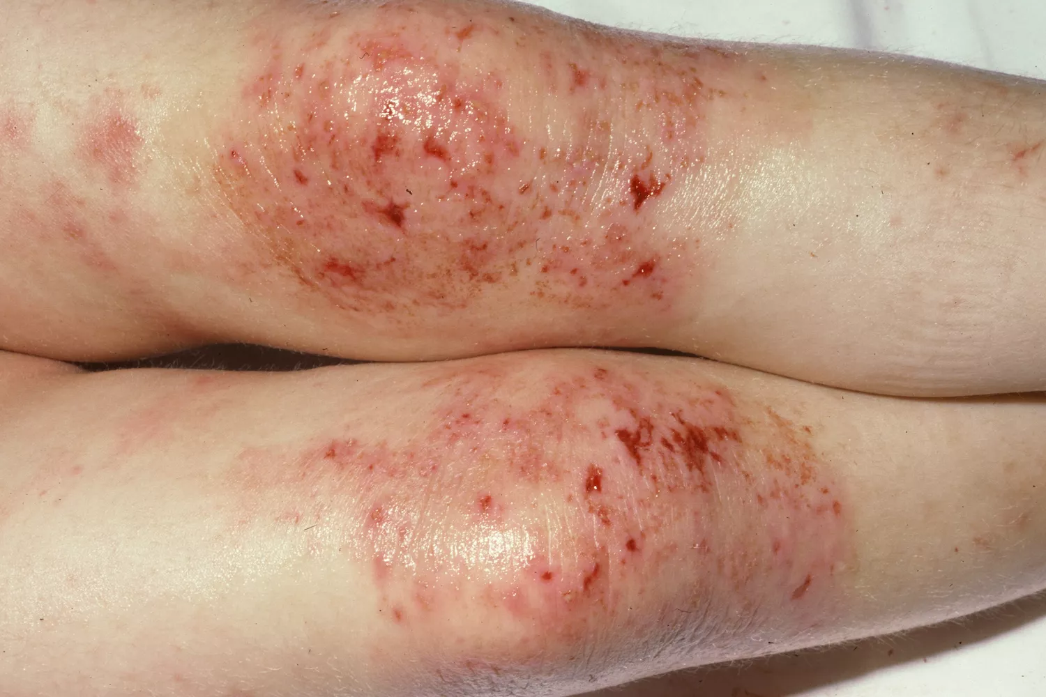 Extensive atopic dermatitis on the legs of a patient.