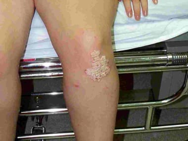 A close-up photograph of a thick, well-defined psoriasis plaque located on the knee.