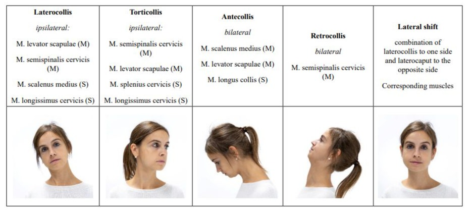 Anatomical diagram showing different types of cervical dystonia and muscle involvement