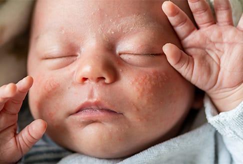 Macro shot of a newborn's cheek with minor acne breakouts and small red bumps.
