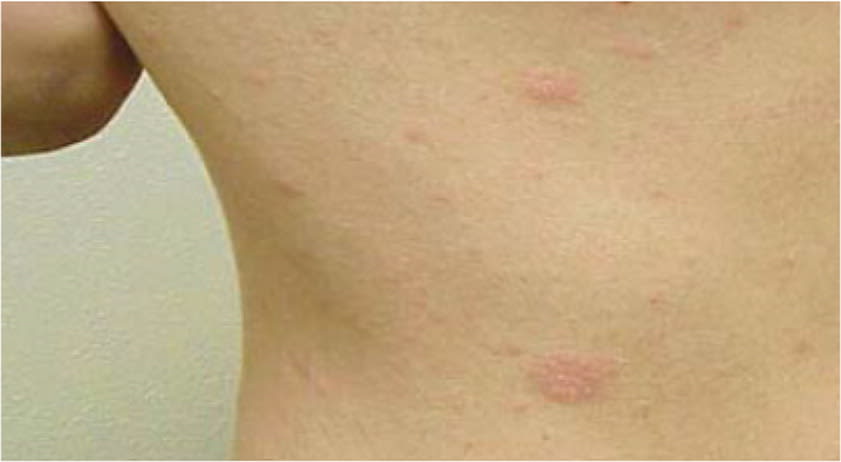 Individual oblong-shaped pink lesions on the skin of the trunk.