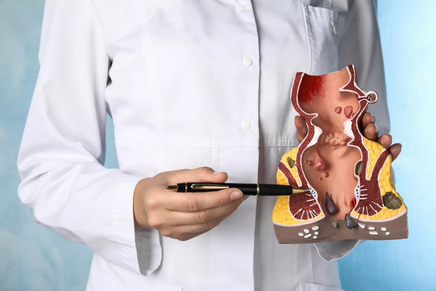 A healthcare professional pointing at an anatomical model of the rectum and anus to explain medical findings.