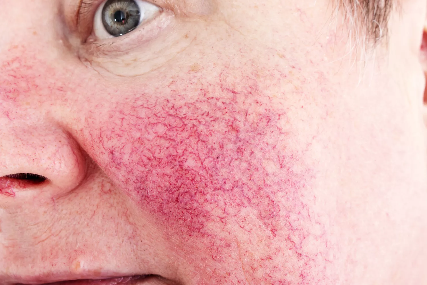 Close-up of facial skin with visible erythema and vascular reactivity.