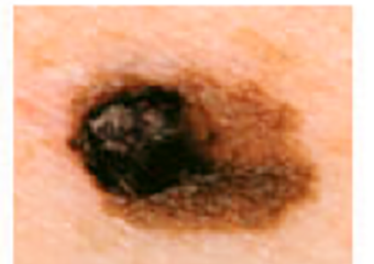 Close-up of a skin lesion with an irregular, asymmetrical shape.