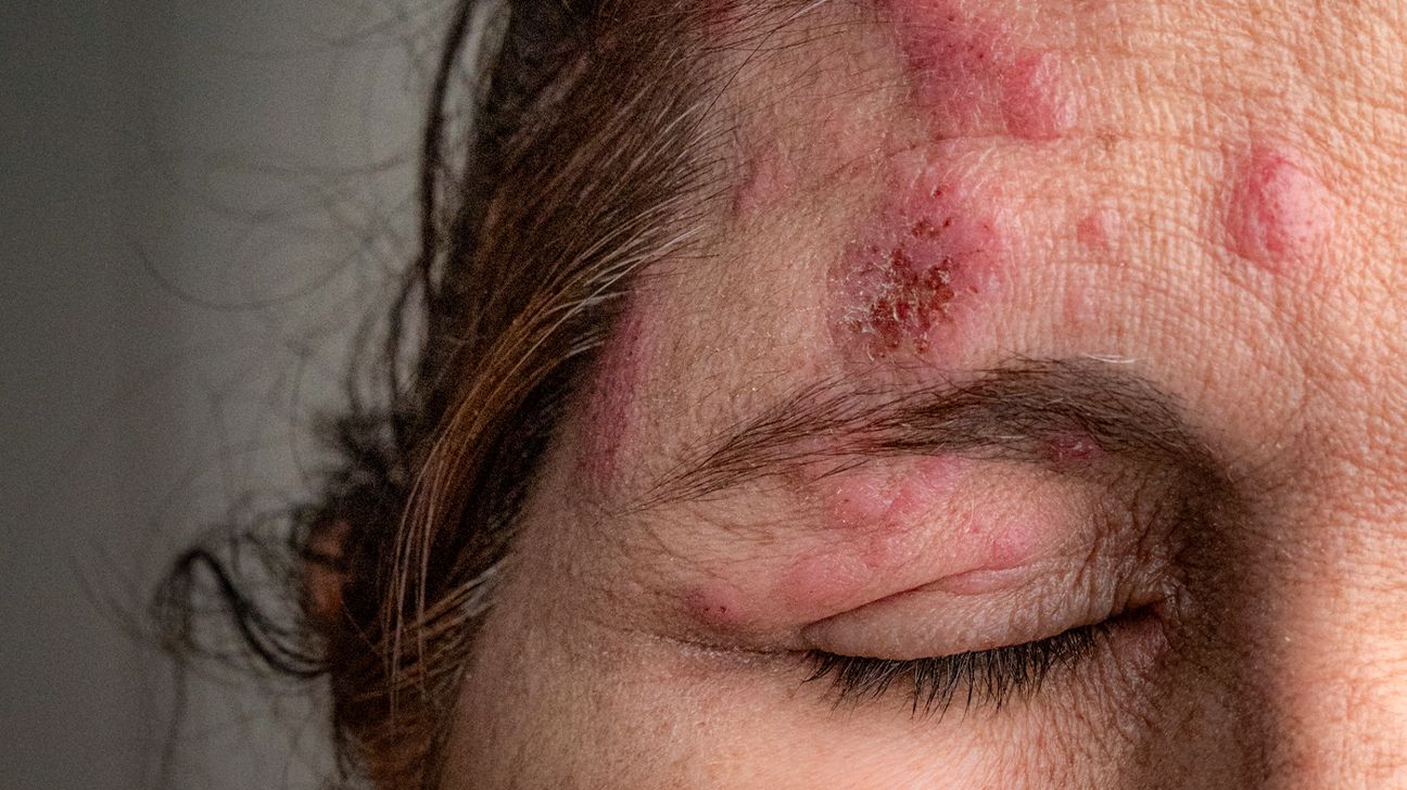 Ocular Shingles: Risks, Symptoms, and Blindness Prevention