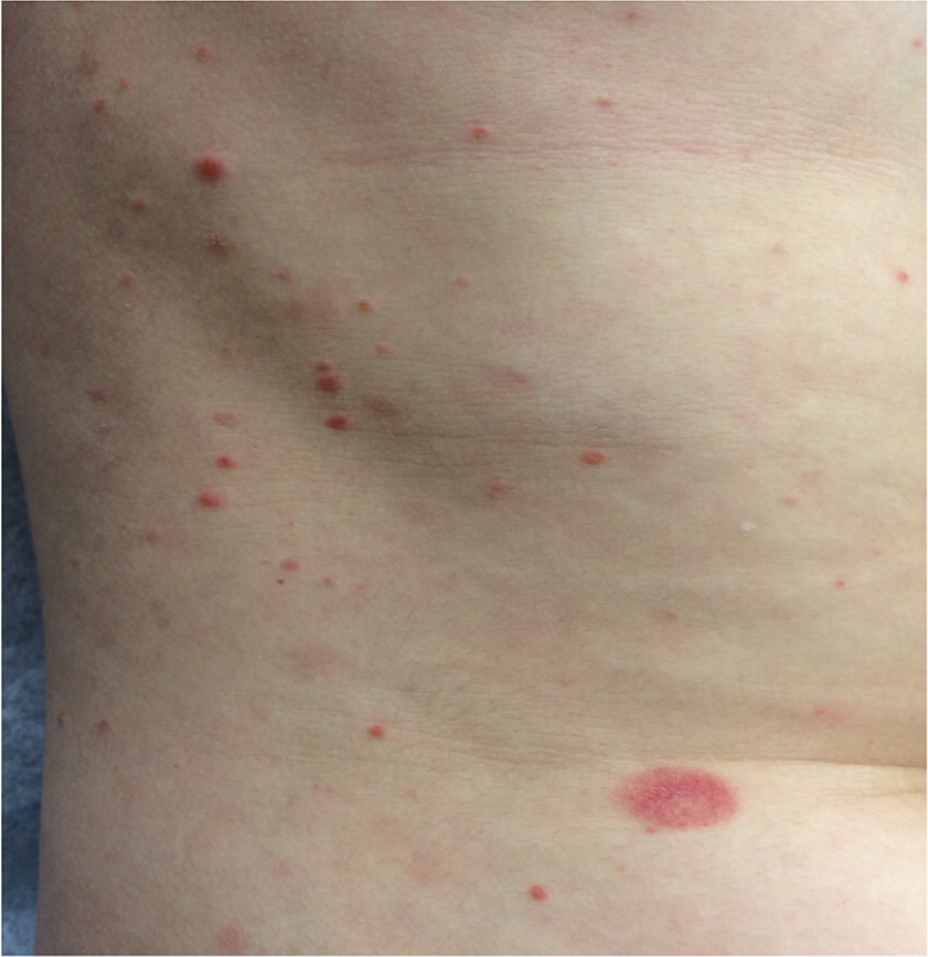View of a person's torso with a large initial patch and several smaller secondary lesions.
